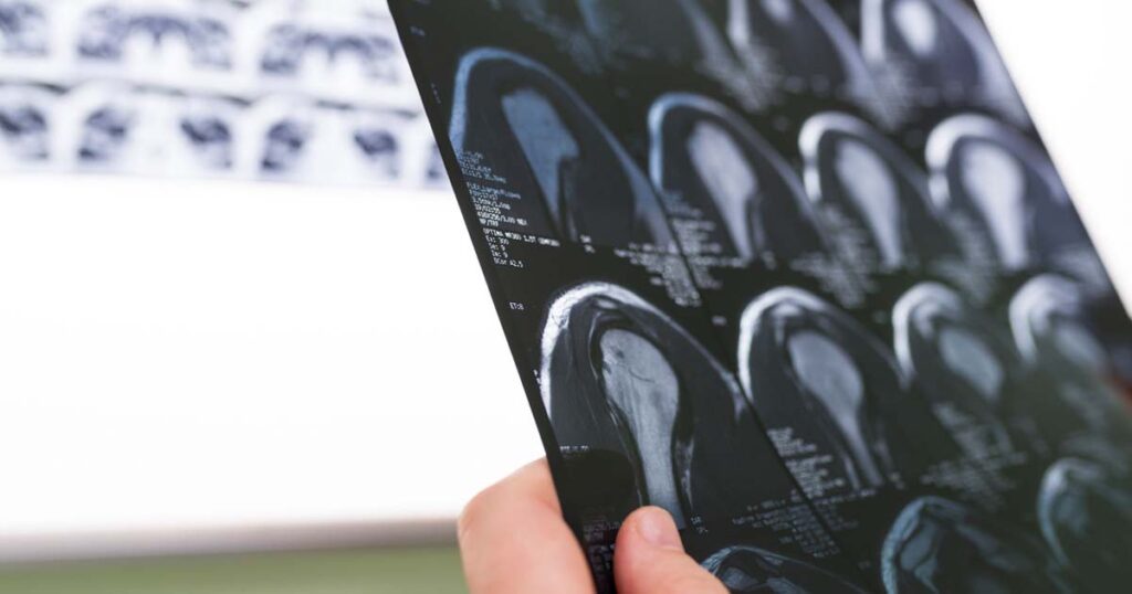 Scans showing the details behind rotator cuff tears