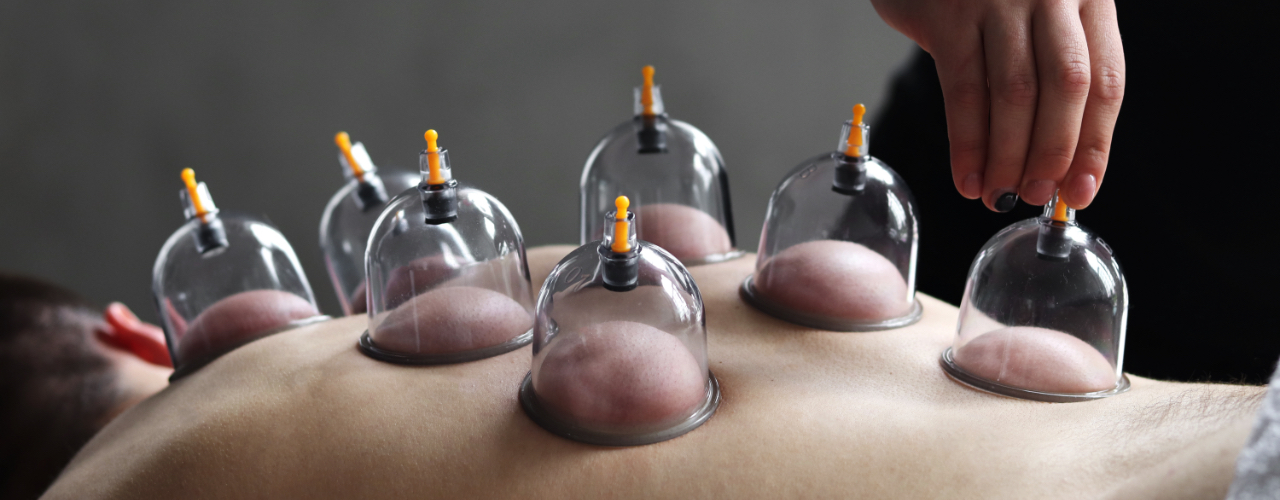 Cupping-Therapy-Kintsugi-Physical-Therapy-&-Wellness-Normandy-Park-WA