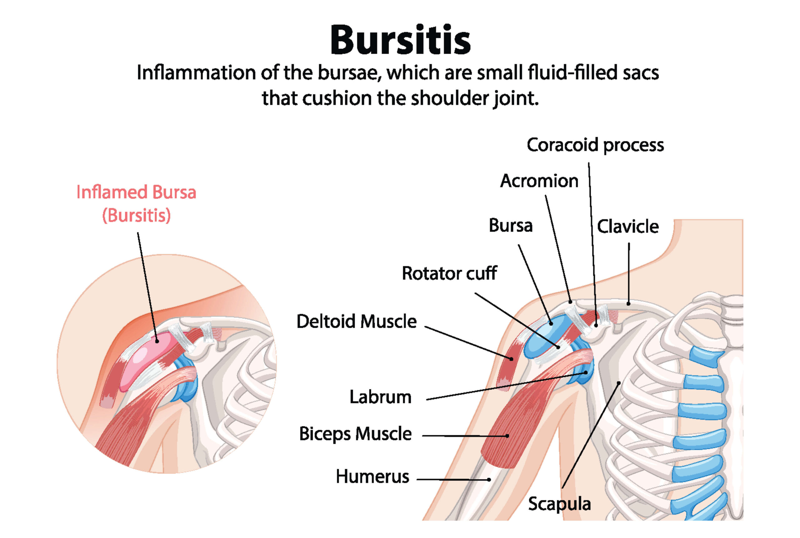 Bursitis