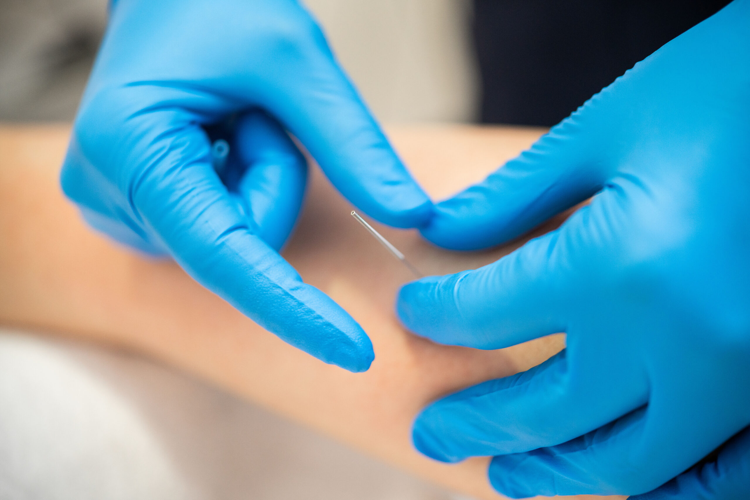 Dry Needling