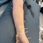 How Physical Therapy Can Combat Carpal Tunnel Syndrome